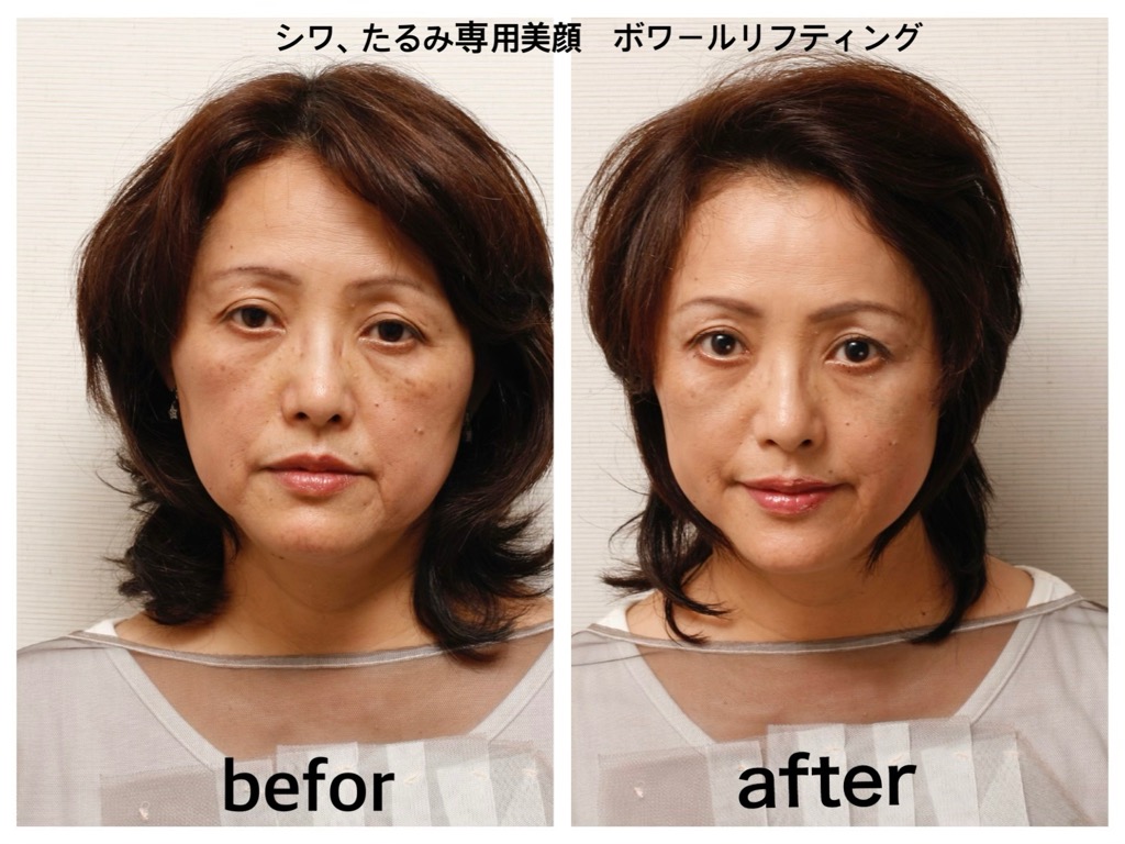 ボワールリフティング イメージ画像