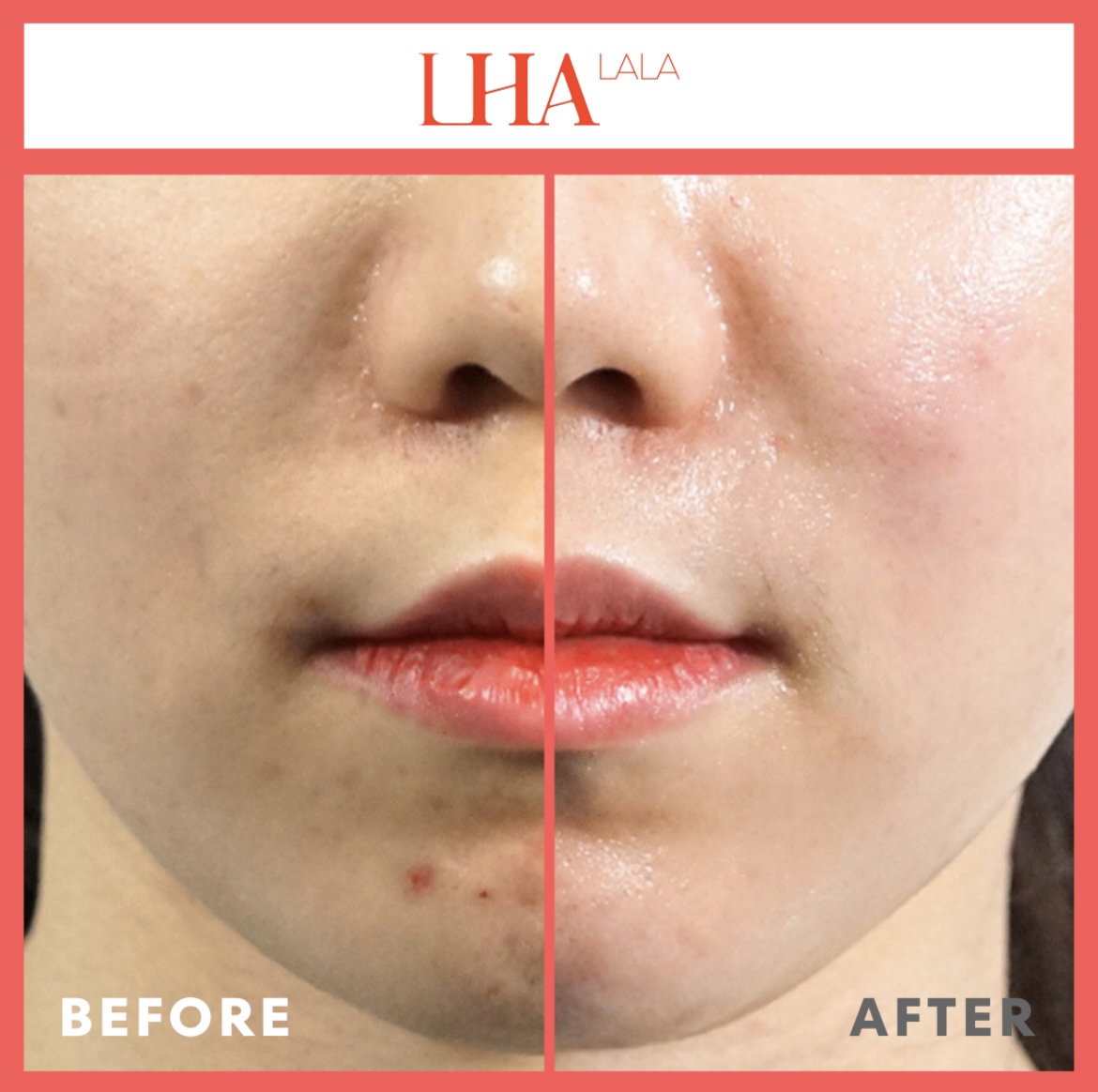 ララピール ビフォーアフター｜ニキビ跡・色素沈着の改善事例