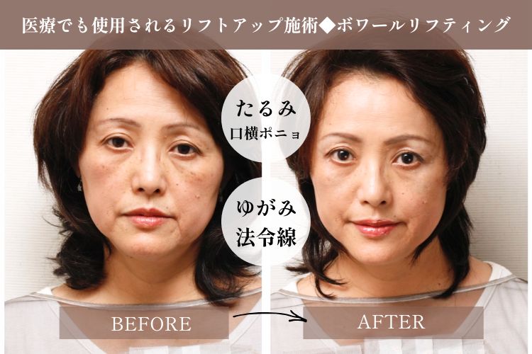 ボワールリフティング 施術前後｜糸リフト・医療ハイフより効果を実感